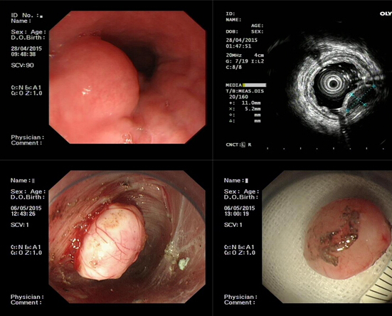 食管間質瘤ster術(內鏡經隧道固有肌層腫瘤挖除術)